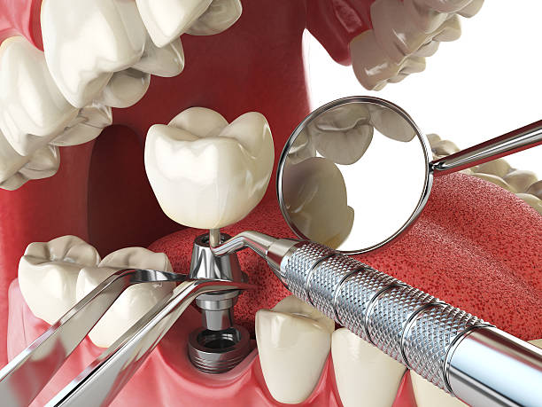 Best Emergency Dental Care for Broken or Chipped Teeth in Hope Mills, NC