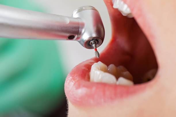Best Emergency Treatment for Dental Infections or Abscesses in Hope Mills, NC